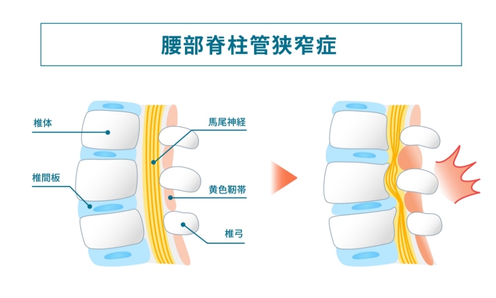 脊柱管狭窄症のしくみ